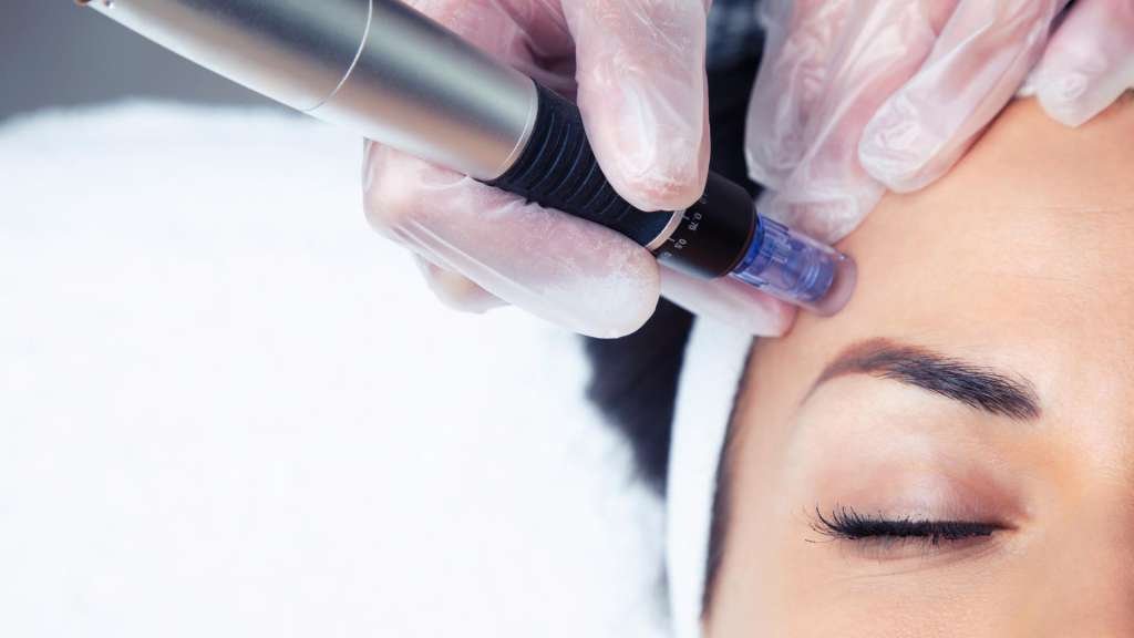 dermapen2