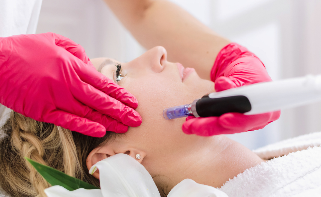 Jak Dermapen potrafi przeprogramować Twoją skórę?